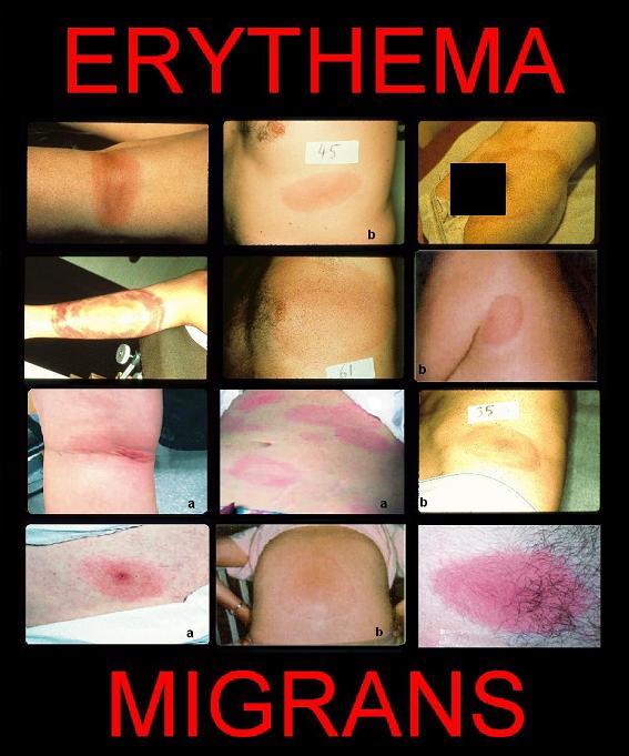 Pictures of Erythema Migrans